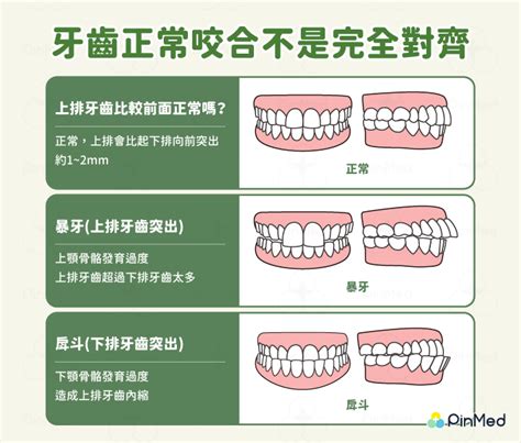 上排牙齒蓋住下排牙齒|介紹理想的咬合關係，整齊的牙齒排列應該是什麼樣。